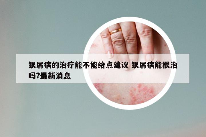 银屑病的治疗能不能给点建议 银屑病能根治吗?最新消息