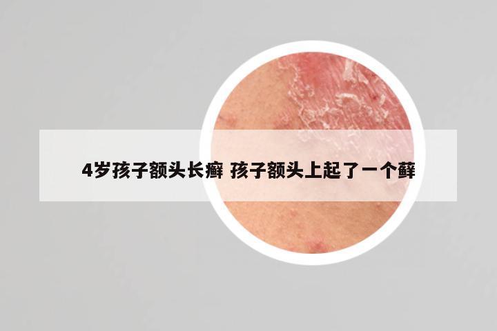 4岁孩子额头长癣 孩子额头上起了一个藓