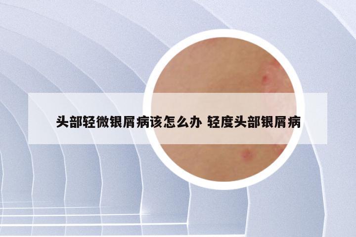 头部轻微银屑病该怎么办 轻度头部银屑病