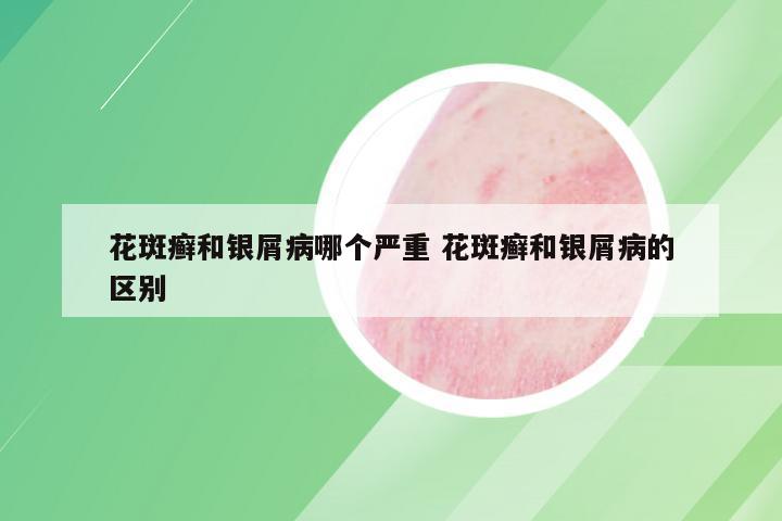 花斑癣和银屑病哪个严重 花斑癣和银屑病的区别