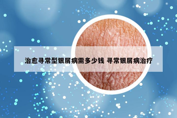 治愈寻常型银屑病需多少钱 寻常银屑病治疗
