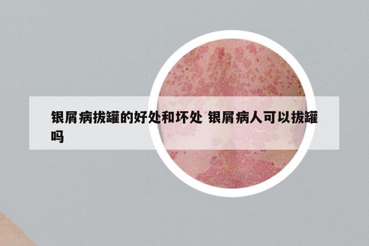 银屑病拔罐的好处和坏处 银屑病人可以拔罐吗
