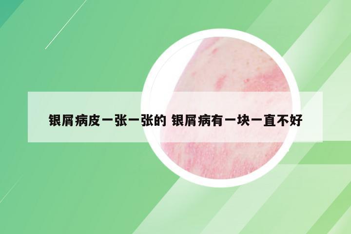银屑病皮一张一张的 银屑病有一块一直不好