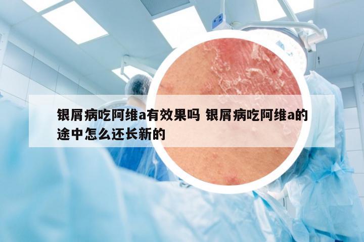 银屑病吃阿维a有效果吗 银屑病吃阿维a的途中怎么还长新的