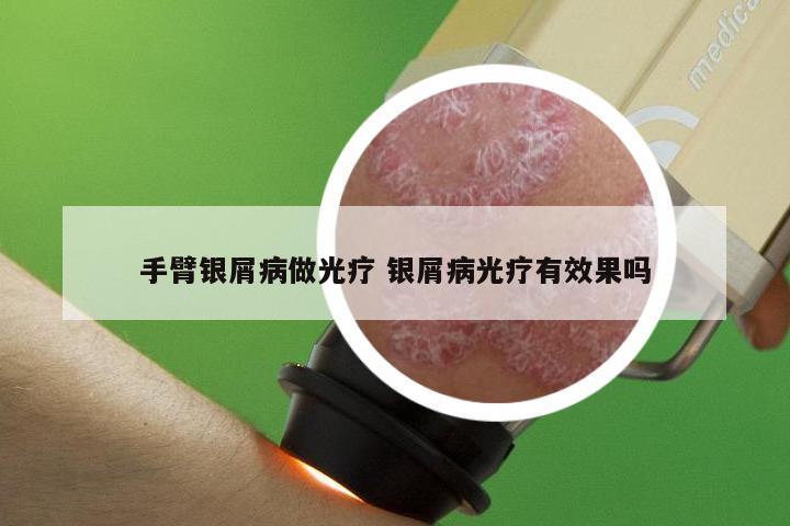 手臂银屑病做光疗 银屑病光疗有效果吗