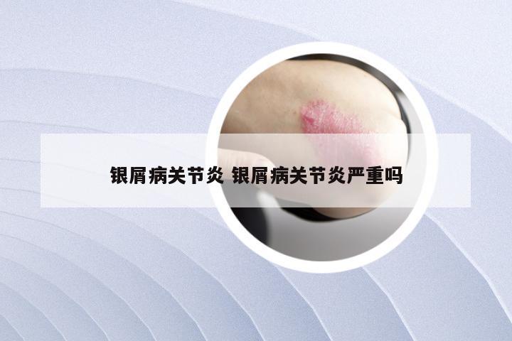 银屑病关节炎 银屑病关节炎严重吗