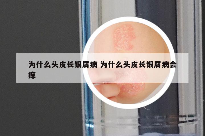 为什么头皮长银屑病 为什么头皮长银屑病会痒