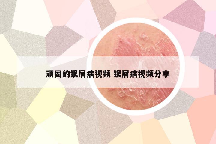 顽固的银屑病视频 银屑病视频分享