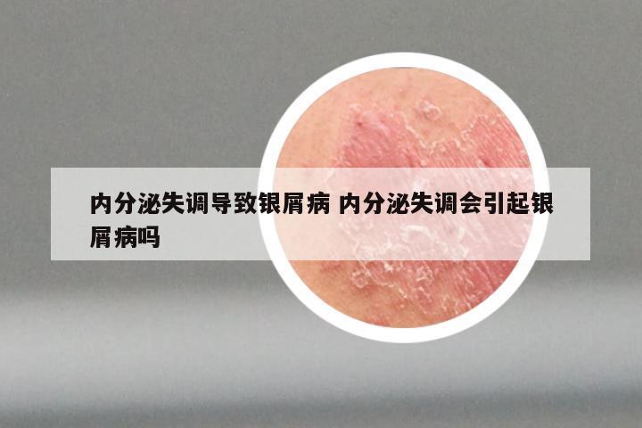 内分泌失调导致银屑病 内分泌失调会引起银屑病吗