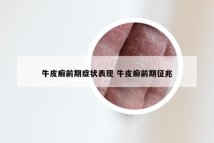牛皮癣前期症状表现 牛皮癣前期征兆