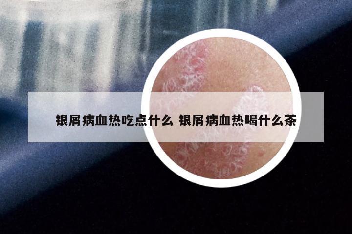 银屑病血热吃点什么 银屑病血热喝什么茶