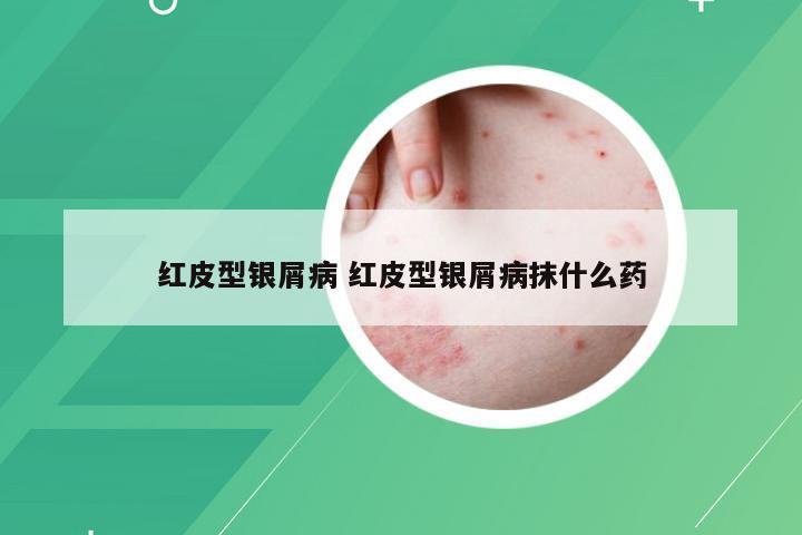 红皮型银屑病 红皮型银屑病抹什么药