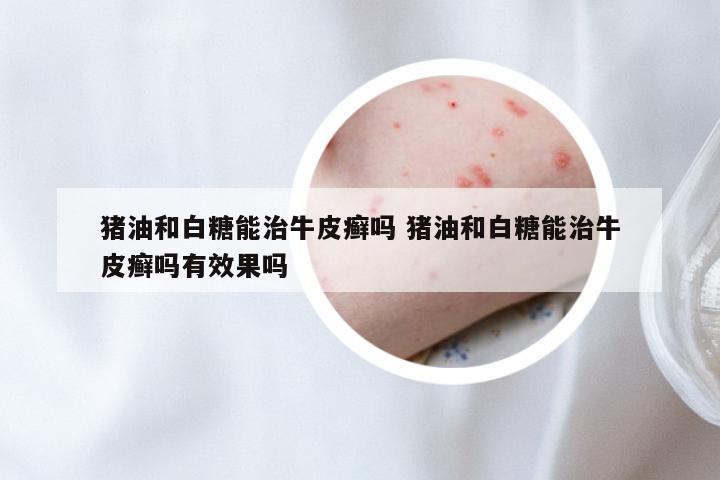 猪油和白糖能治牛皮癣吗 猪油和白糖能治牛皮癣吗有效果吗