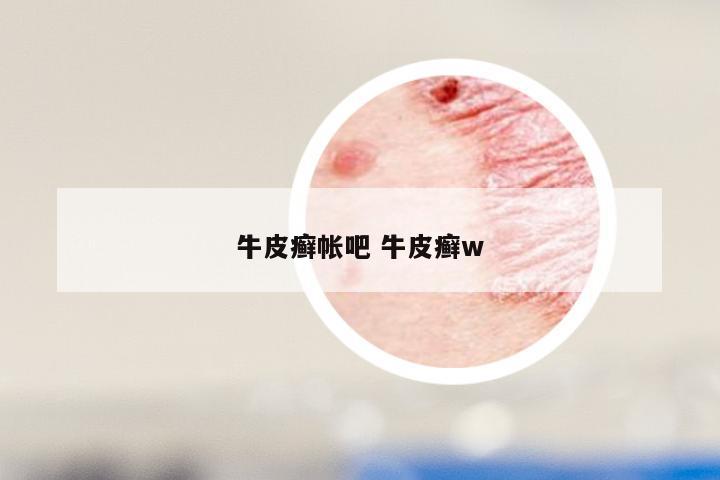 牛皮癣帐吧 牛皮癣w
