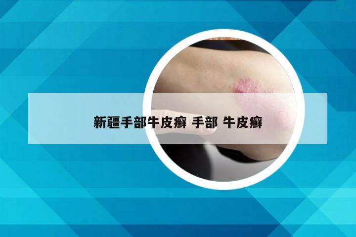 新疆手部牛皮癣 手部 牛皮癣