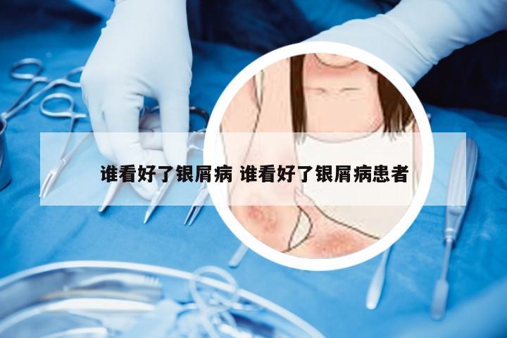 谁看好了银屑病 谁看好了银屑病患者