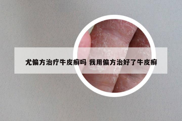 尤偏方治疗牛皮癣吗 我用偏方治好了牛皮癣