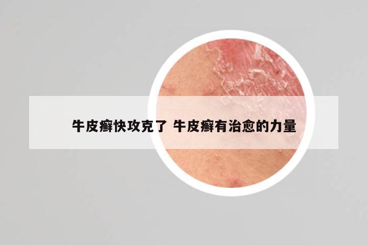 牛皮癣快攻克了 牛皮癣有治愈的力量