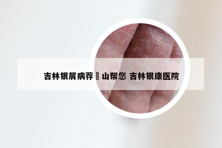 吉林银屑病荐崋山帮您 吉林银康医院