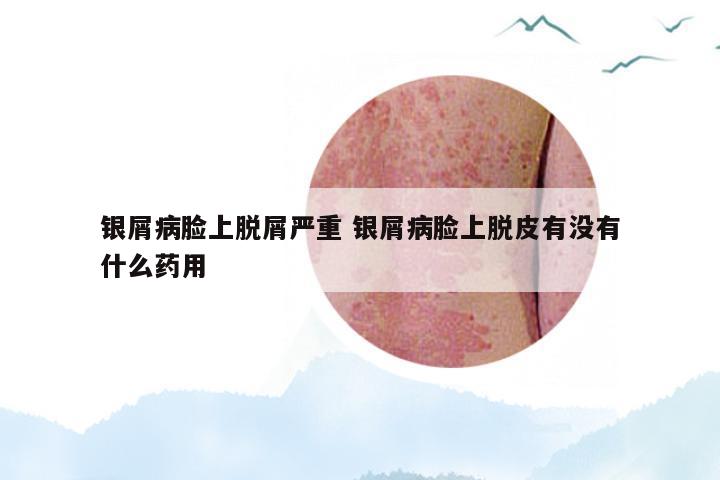 银屑病脸上脱屑严重 银屑病脸上脱皮有没有什么药用