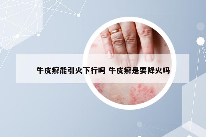 牛皮癣能引火下行吗 牛皮癣是要降火吗