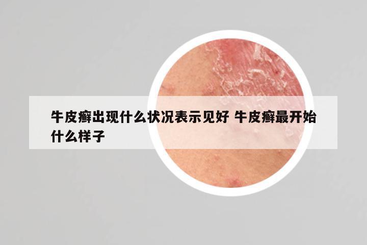 牛皮癣出现什么状况表示见好 牛皮癣最开始什么样子