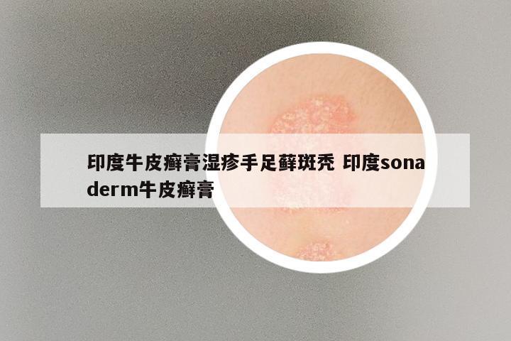 印度牛皮癣膏湿疹手足藓斑秃 印度sonaderm牛皮癣膏