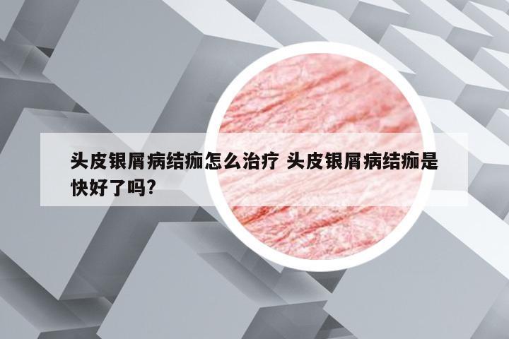 头皮银屑病结痂怎么治疗 头皮银屑病结痂是快好了吗?