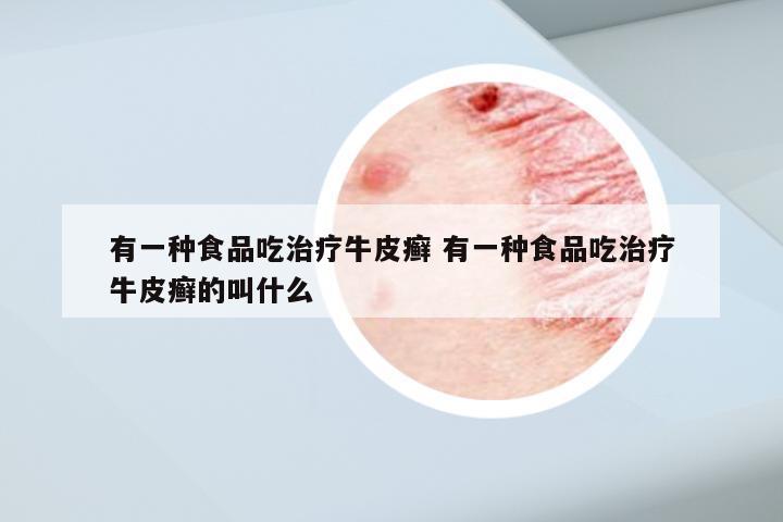 有一种食品吃治疗牛皮癣 有一种食品吃治疗牛皮癣的叫什么