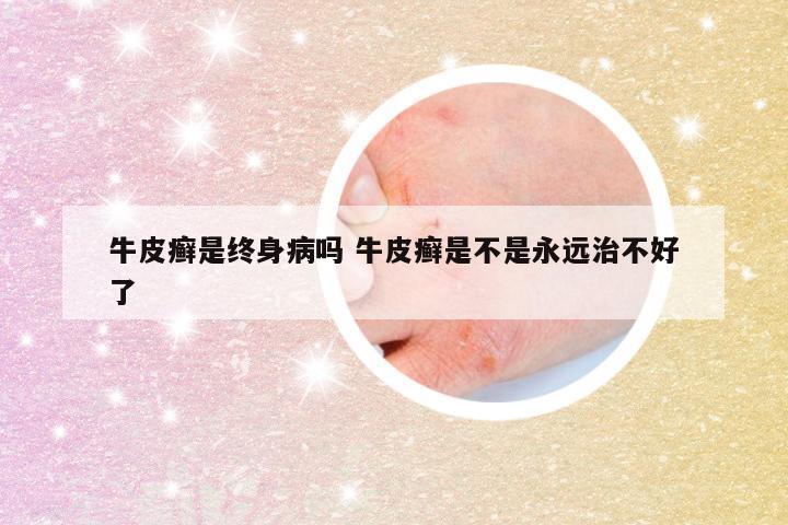 牛皮癣是终身病吗 牛皮癣是不是永远治不好了