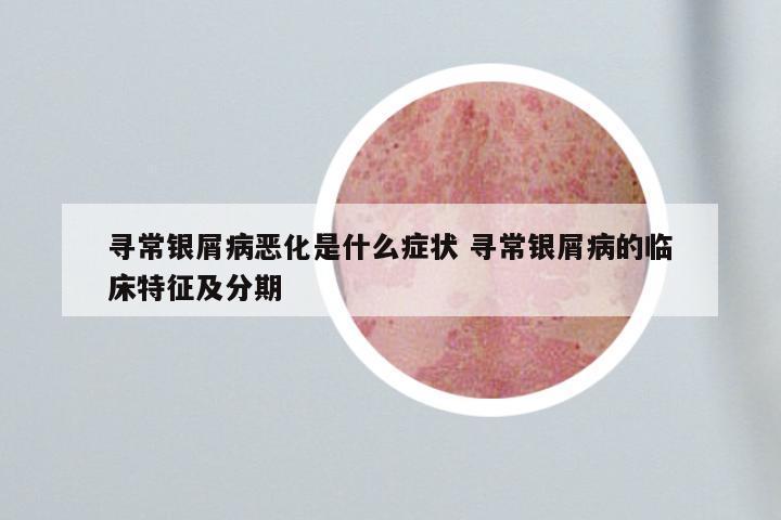 寻常银屑病恶化是什么症状 寻常银屑病的临床特征及分期