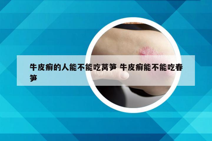 牛皮癣的人能不能吃莴笋 牛皮癣能不能吃春笋
