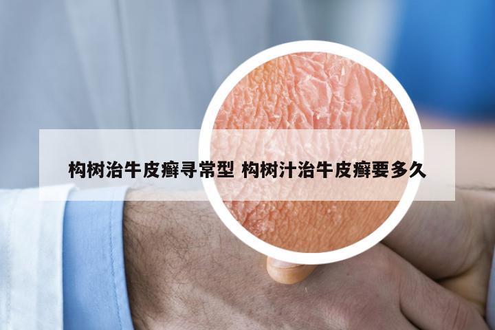 构树治牛皮癣寻常型 构树汁治牛皮癣要多久