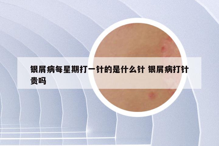 银屑病每星期打一针的是什么针 银屑病打针贵吗