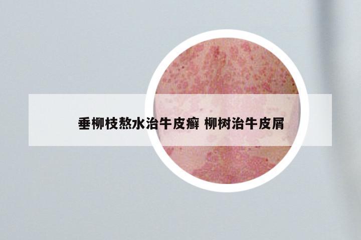 垂柳枝熬水治牛皮癣 柳树治牛皮屑