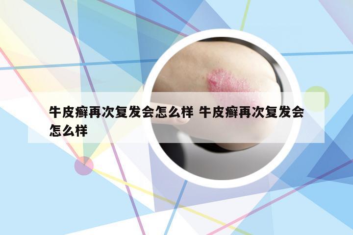 牛皮癣再次复发会怎么样 牛皮癣再次复发会怎么样