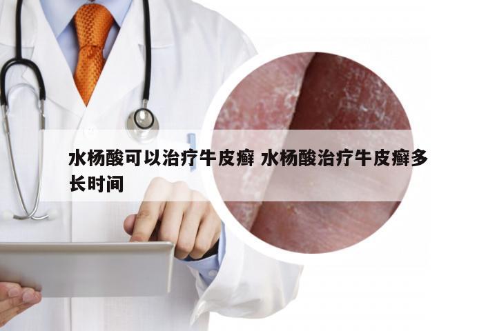 水杨酸可以治疗牛皮癣 水杨酸治疗牛皮癣多长时间