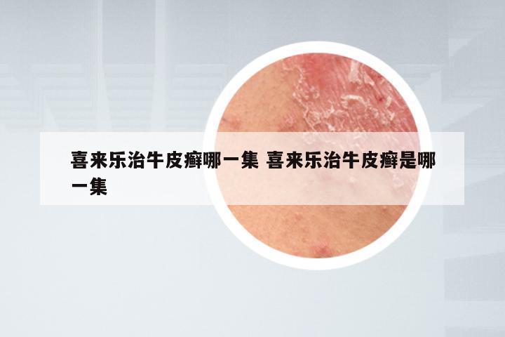 喜来乐治牛皮癣哪一集 喜来乐治牛皮癣是哪一集