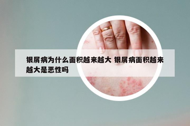 银屑病为什么面积越来越大 银屑病面积越来越大是恶性吗