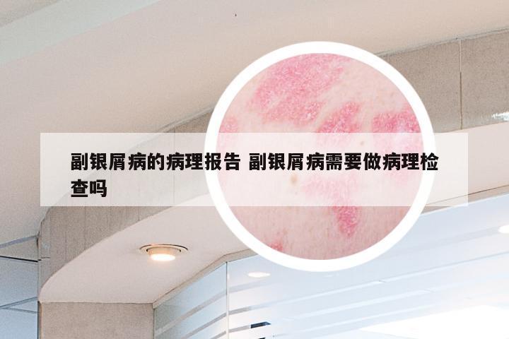 副银屑病的病理报告 副银屑病需要做病理检查吗