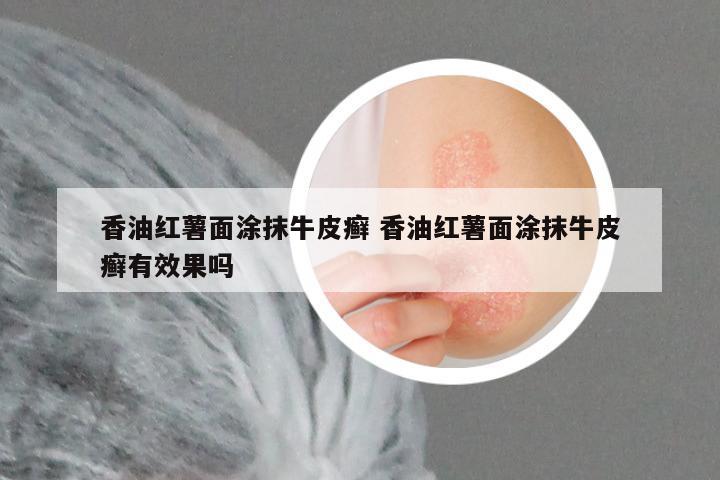 香油红薯面涂抹牛皮癣 香油红薯面涂抹牛皮癣有效果吗