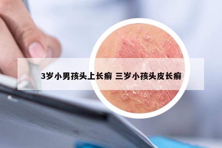 3岁小男孩头上长癣 三岁小孩头皮长癣