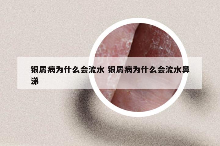 银屑病为什么会流水 银屑病为什么会流水鼻涕