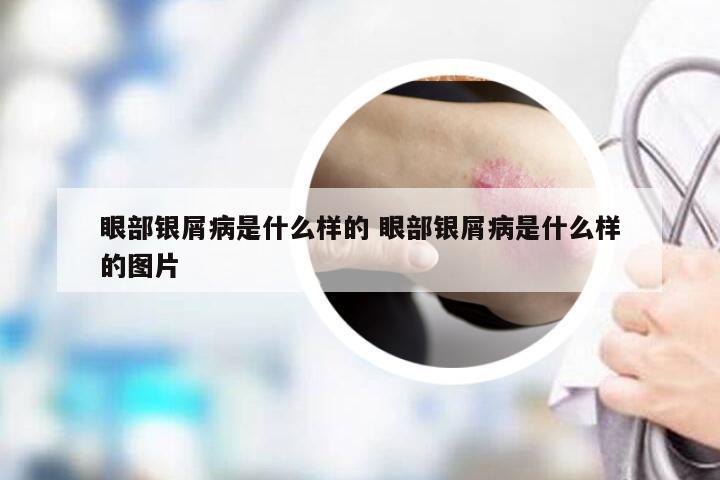 眼部银屑病是什么样的 眼部银屑病是什么样的图片