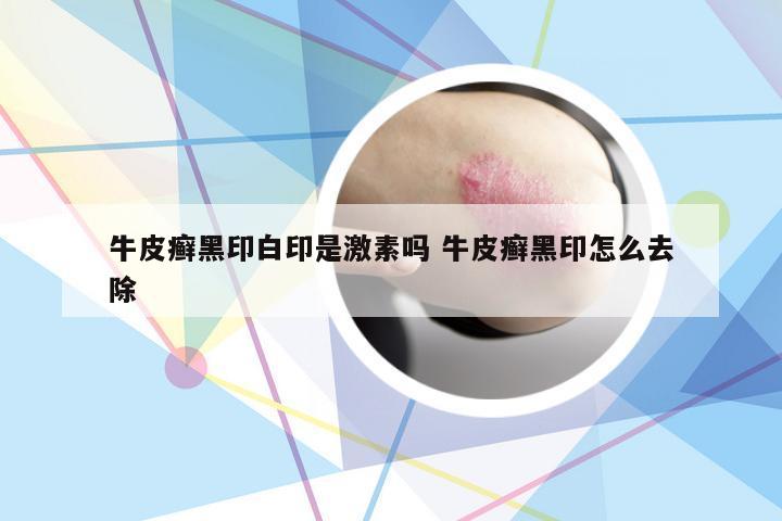 牛皮癣黑印白印是激素吗 牛皮癣黑印怎么去除