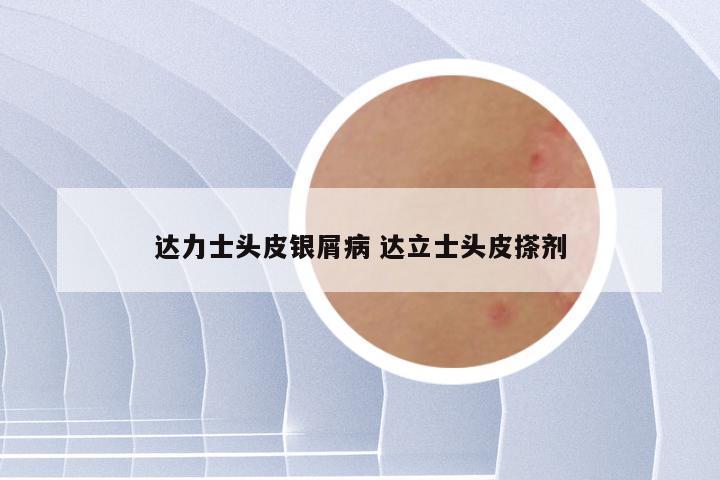 达力士头皮银屑病 达立士头皮搽剂
