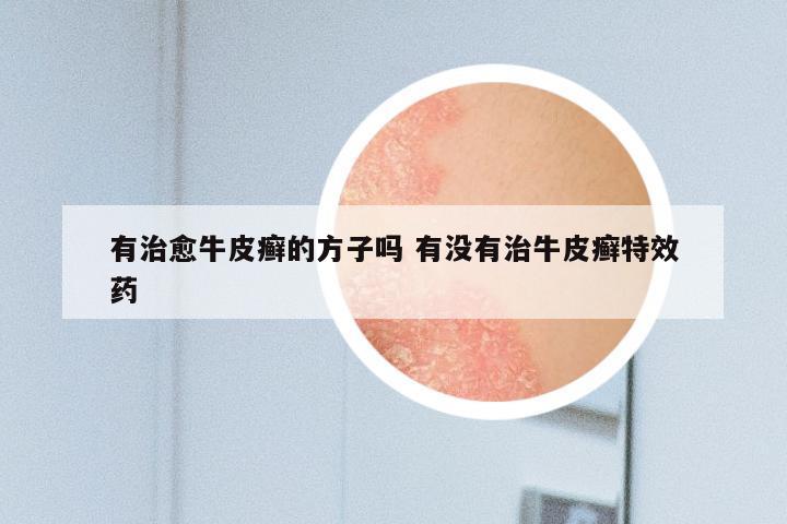 有治愈牛皮癣的方子吗 有没有治牛皮癣特效药