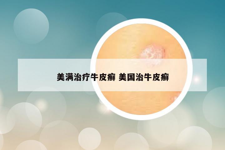美满治疗牛皮癣 美国治牛皮癣