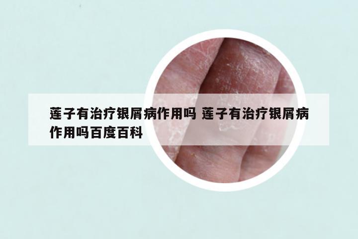 莲子有治疗银屑病作用吗 莲子有治疗银屑病作用吗百度百科