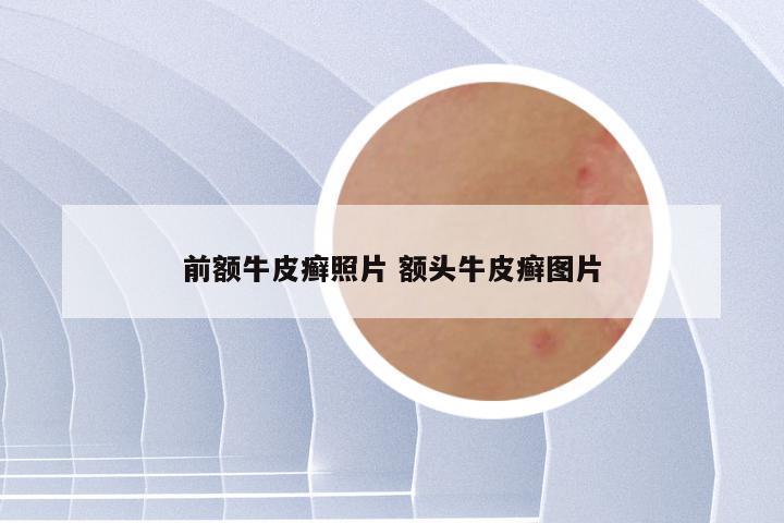 前额牛皮癣照片 额头牛皮癣图片